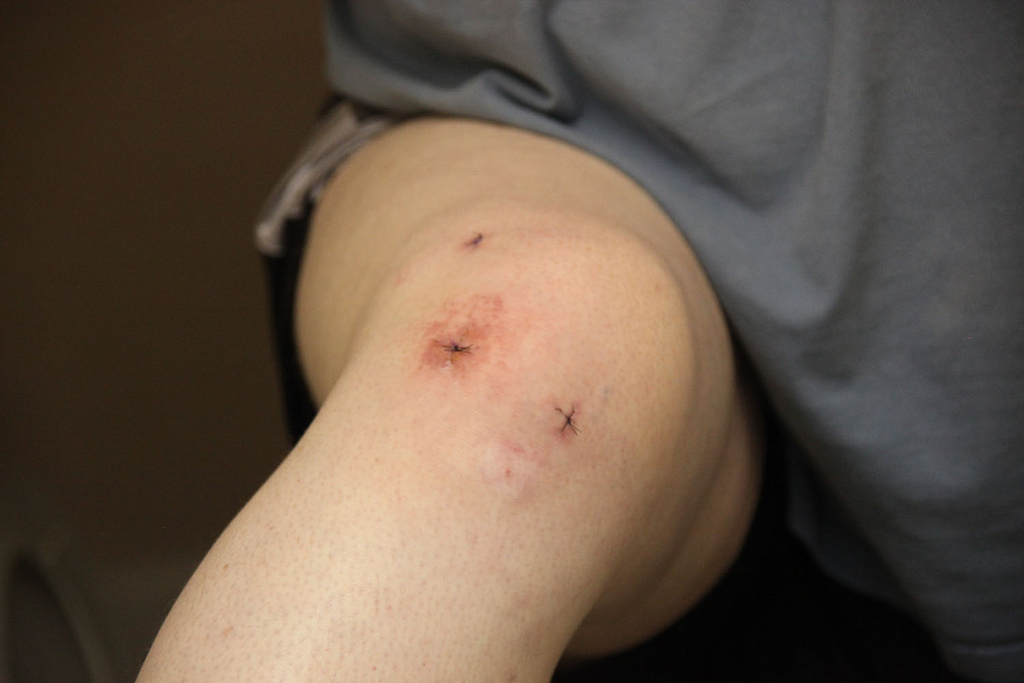kijkoperatie knie